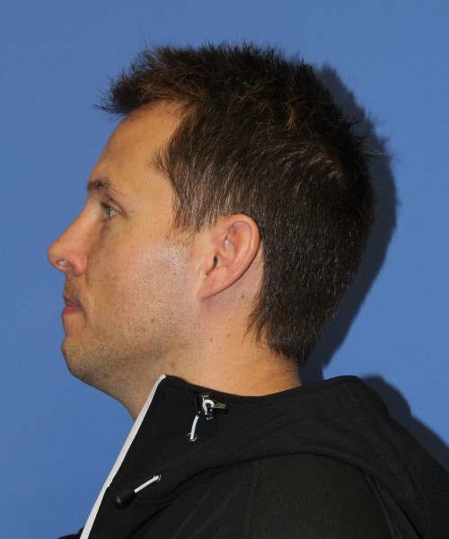 Rhinoplasty 2032 – Click HERE for more views after photo. Individual results may vary.