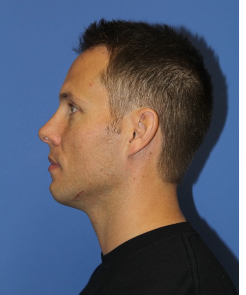 Rhinoplasty 2032 – Click HERE for more views before photo. Individual results may vary.