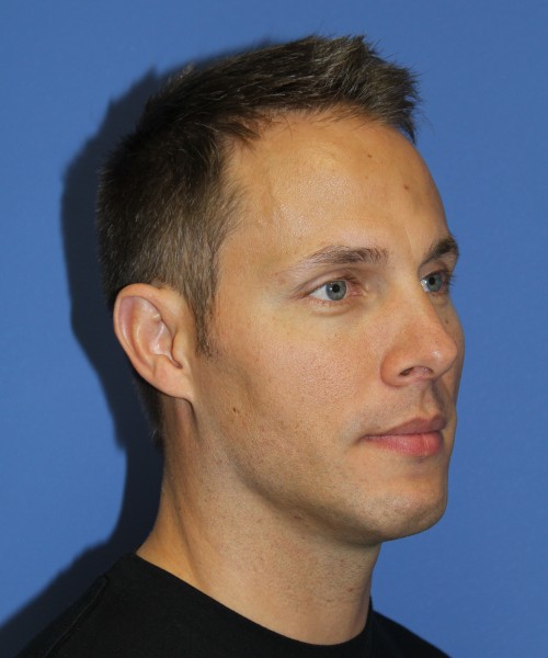 Rhinoplasty 2032 – Click HERE for more views before photo. Individual results may vary.