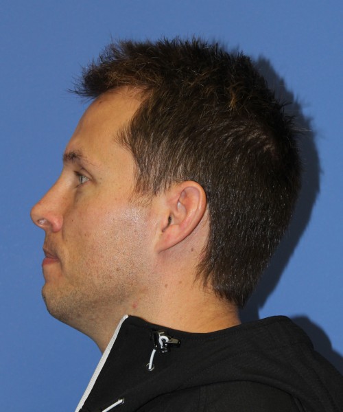 Rhinoplasty 2032 – Click HERE for more views after photo. Individual results may vary.