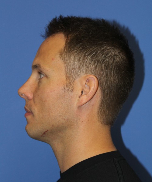 Rhinoplasty 2032 – Click HERE for more views before photo. Individual results may vary.