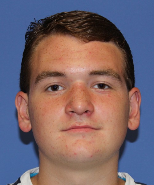 Rhinoplasty 2047 – Click HERE for more views after photo. Individual results may vary.