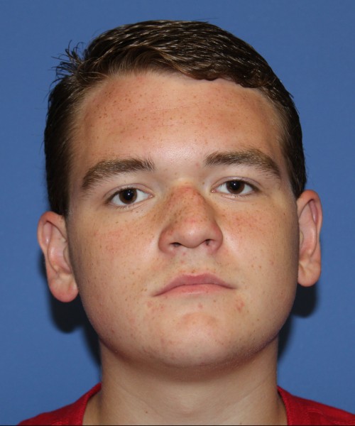 Rhinoplasty 2047 – Click HERE for more views before photo. Individual results may vary.