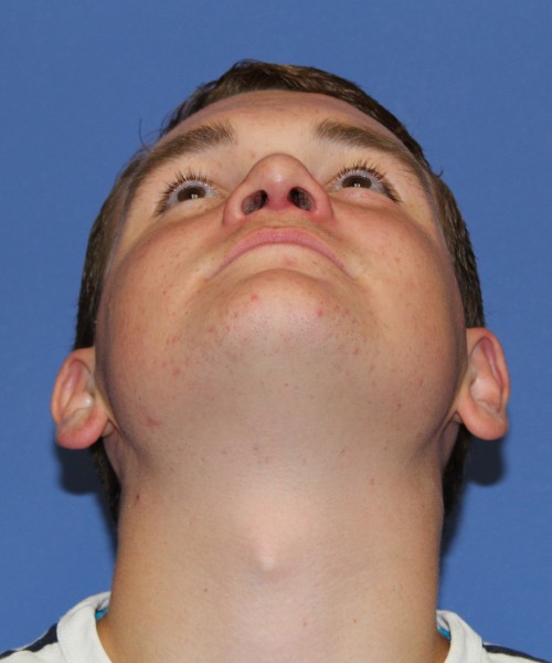 Rhinoplasty 2047 – Click HERE for more views after photo. Individual results may vary.