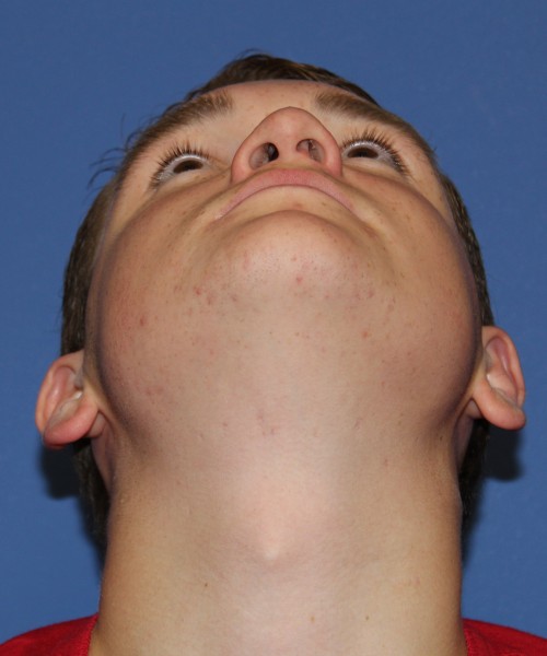 Rhinoplasty 2047 – Click HERE for more views before photo. Individual results may vary.