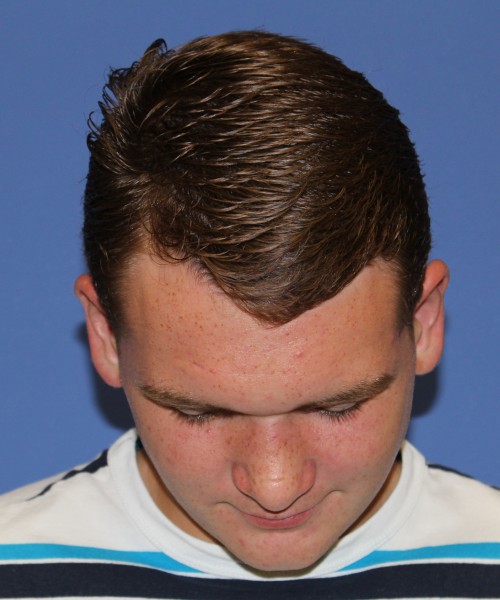 Rhinoplasty 2047 – Click HERE for more views after photo. Individual results may vary.