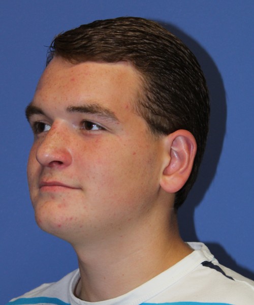 Rhinoplasty 2047 – Click HERE for more views after photo. Individual results may vary.
