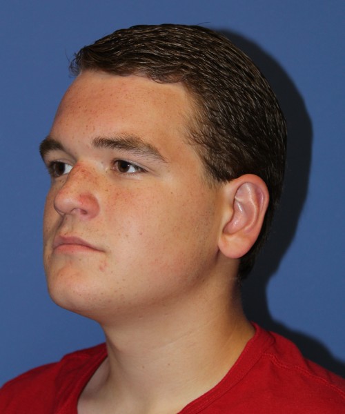 Rhinoplasty 2047 – Click HERE for more views before photo. Individual results may vary.