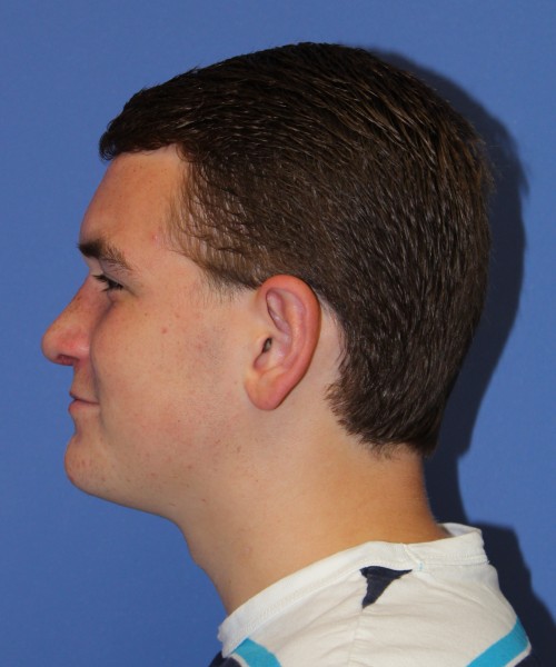 Rhinoplasty 2047 – Click HERE for more views after photo. Individual results may vary.
