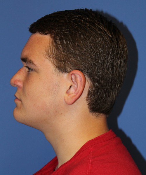 Rhinoplasty 2047 – Click HERE for more views before photo. Individual results may vary.