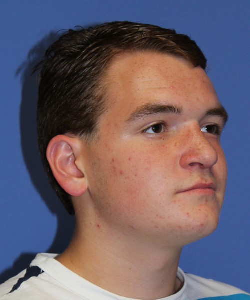 Rhinoplasty 2047 – Click HERE for more views after photo. Individual results may vary.