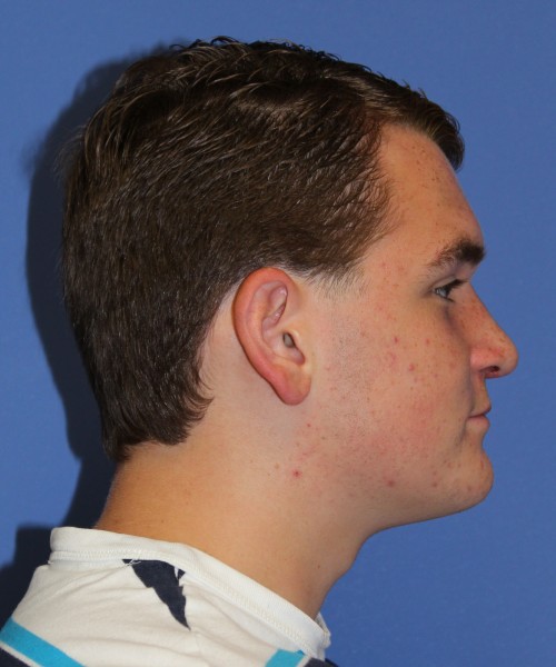Rhinoplasty 2047 – Click HERE for more views after photo. Individual results may vary.