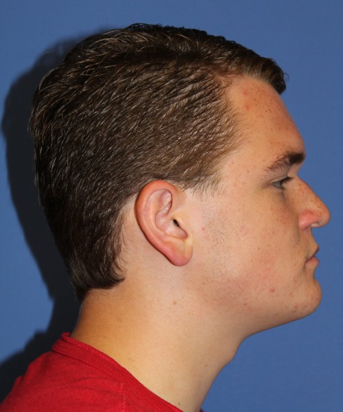 Rhinoplasty 2047 – Click HERE for more views before photo. Individual results may vary.