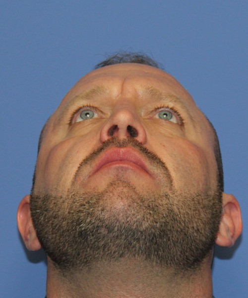 Rhinoplasty 2062 – Click HERE for more views after photo. Individual results may vary.