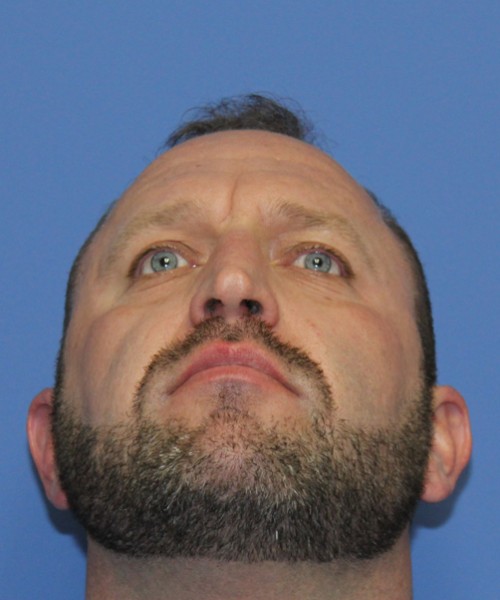 Rhinoplasty 2062 – Click HERE for more views before photo. Individual results may vary.