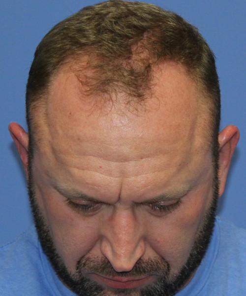 Rhinoplasty 2062 – Click HERE for more views before photo. Individual results may vary.