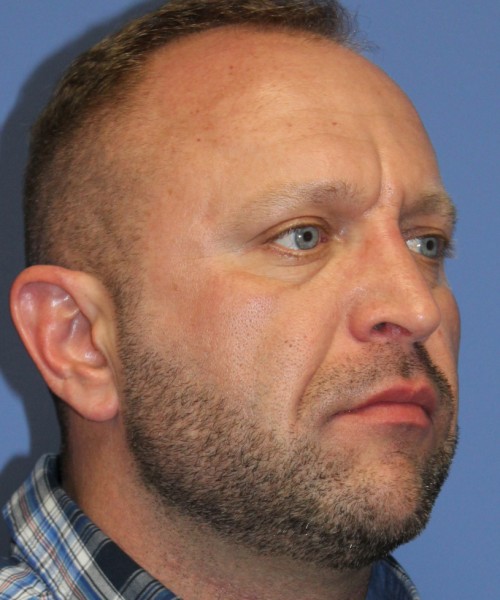 Rhinoplasty 2062 – Click HERE for more views after photo. Individual results may vary.