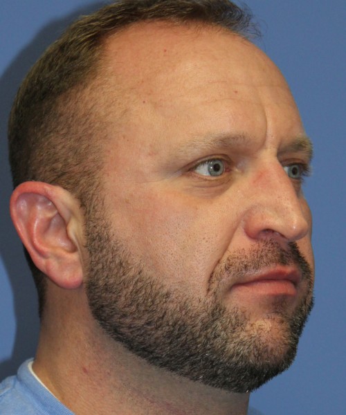 Rhinoplasty 2062 – Click HERE for more views before photo. Individual results may vary.