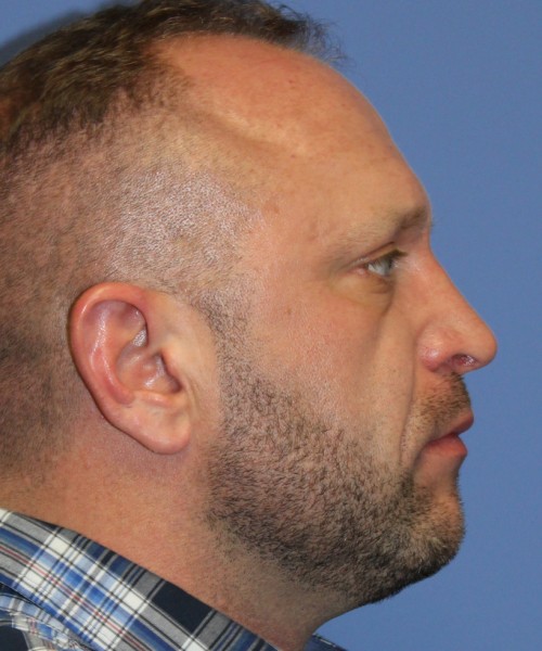 Rhinoplasty 2062 – Click HERE for more views after photo. Individual results may vary.