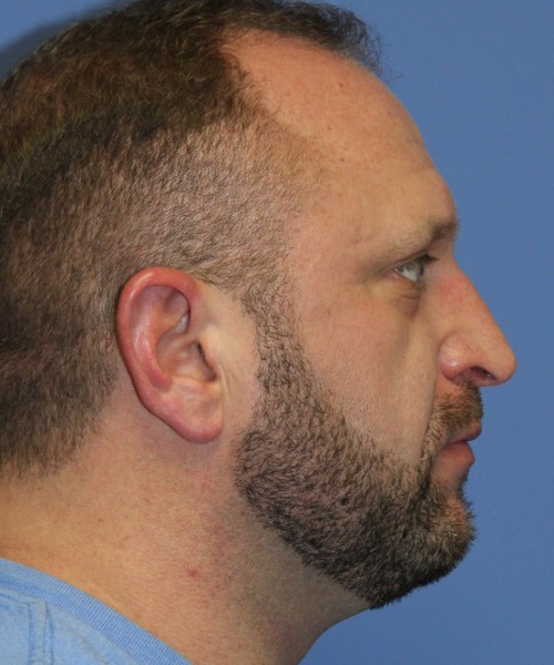 Rhinoplasty 2062 – Click HERE for more views before photo. Individual results may vary.