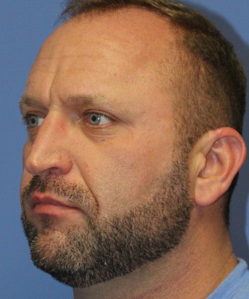 Rhinoplasty 2062 – Click HERE for more views before photo. Individual results may vary.