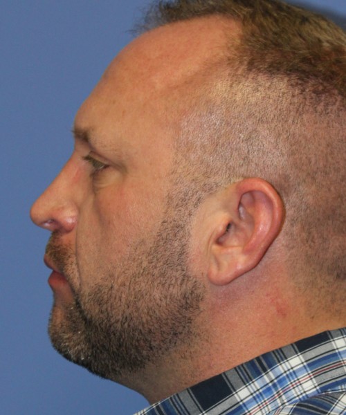 Rhinoplasty 2062 – Click HERE for more views after photo. Individual results may vary.