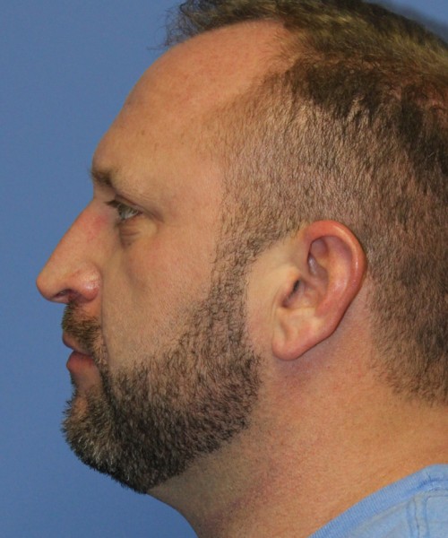 Rhinoplasty 2062 – Click HERE for more views before photo. Individual results may vary.