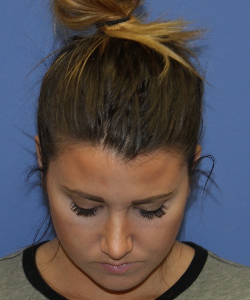 Rhinoplasty 2077 – Click HERE for more views after photo. Individual results may vary.