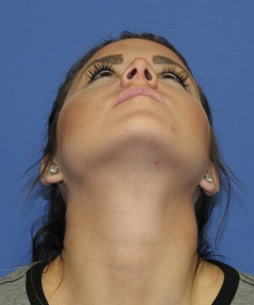 Rhinoplasty 2077 – Click HERE for more views after photo. Individual results may vary.