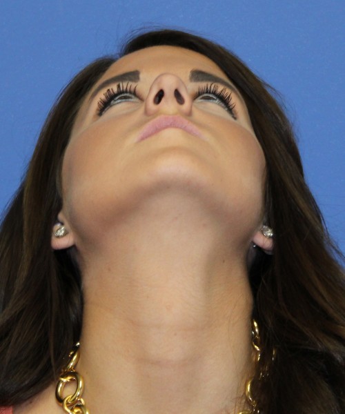 Rhinoplasty 2077 – Click HERE for more views before photo. Individual results may vary.