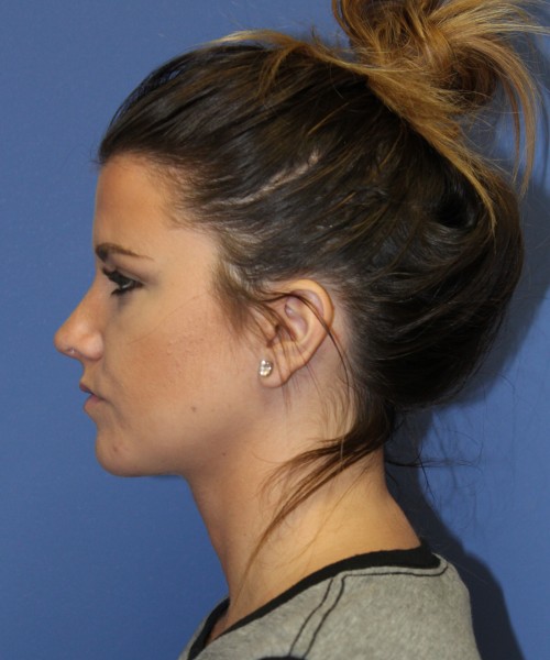 Rhinoplasty 2077 – Click HERE for more views after photo. Individual results may vary.
