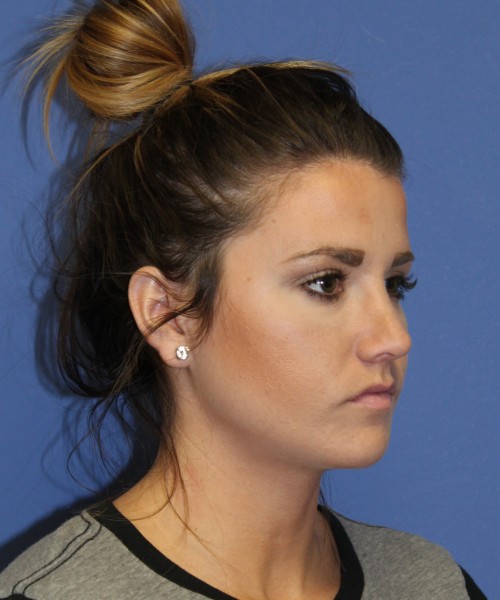 Rhinoplasty 2077 – Click HERE for more views after photo. Individual results may vary.