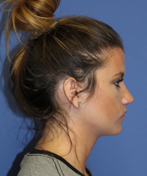 Rhinoplasty 2077 – Click HERE for more views after photo. Individual results may vary.