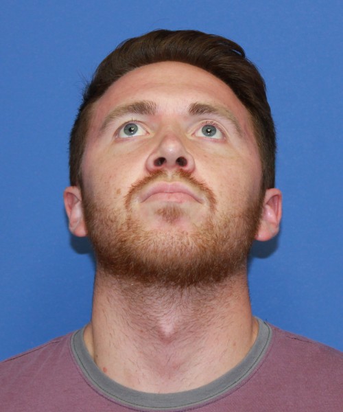 Rhinoplasty 2182 – Click HERE for more views after photo. Individual results may vary.