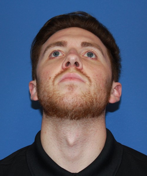 Rhinoplasty 2182 – Click HERE for more views before photo. Individual results may vary.