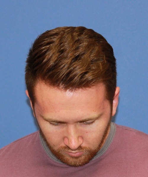 Rhinoplasty 2182 – Click HERE for more views after photo. Individual results may vary.