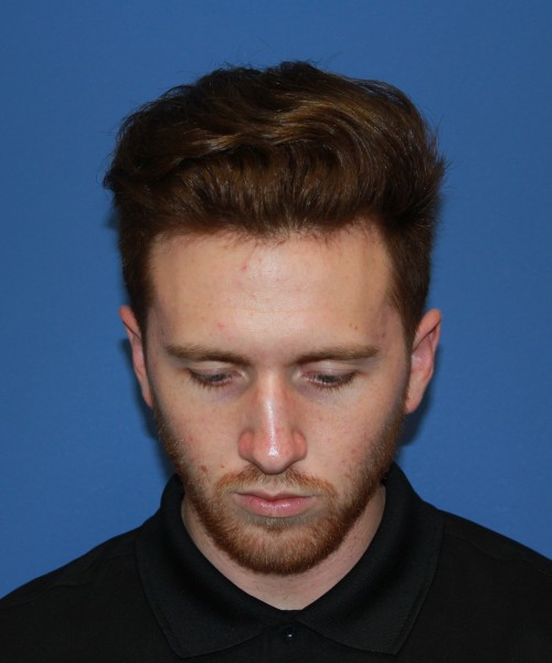 Rhinoplasty 2182 – Click HERE for more views before photo. Individual results may vary.
