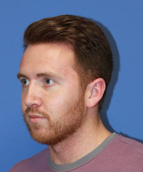 Rhinoplasty 2182 – Click HERE for more views after photo. Individual results may vary.