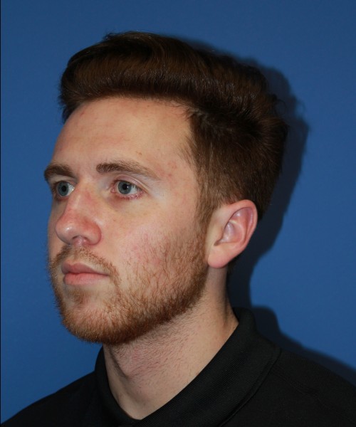 Rhinoplasty 2182 – Click HERE for more views before photo. Individual results may vary.