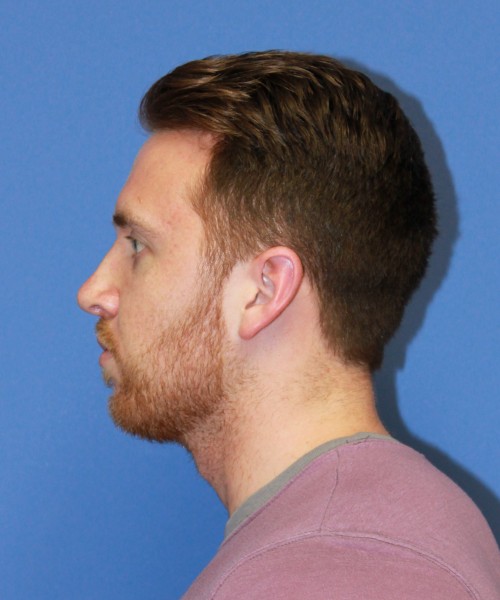 Rhinoplasty 2182 – Click HERE for more views after photo. Individual results may vary.