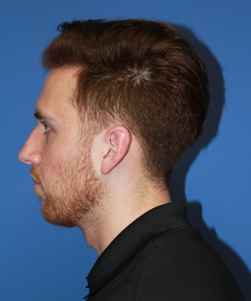 Rhinoplasty 2182 – Click HERE for more views before photo. Individual results may vary.