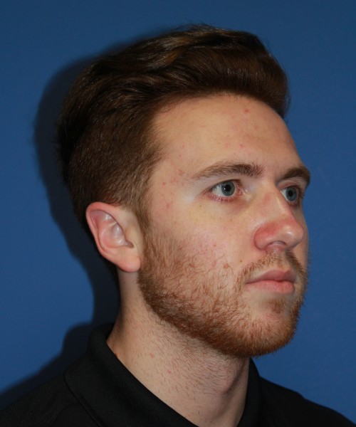 Rhinoplasty 2182 – Click HERE for more views before photo. Individual results may vary.
