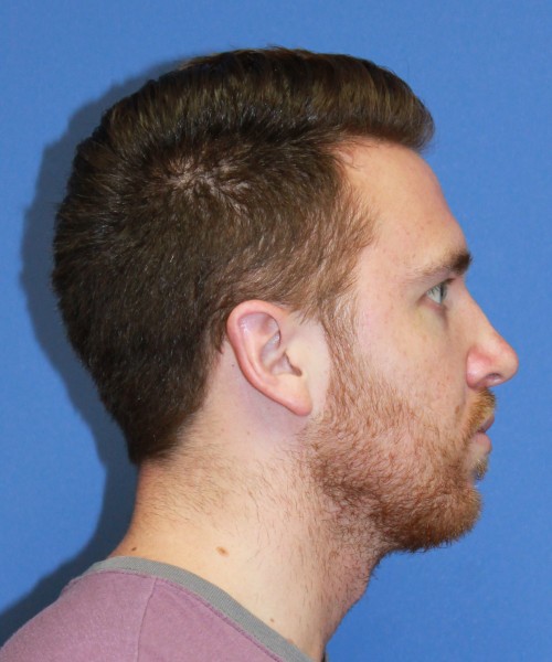 Rhinoplasty 2182 – Click HERE for more views after photo. Individual results may vary.