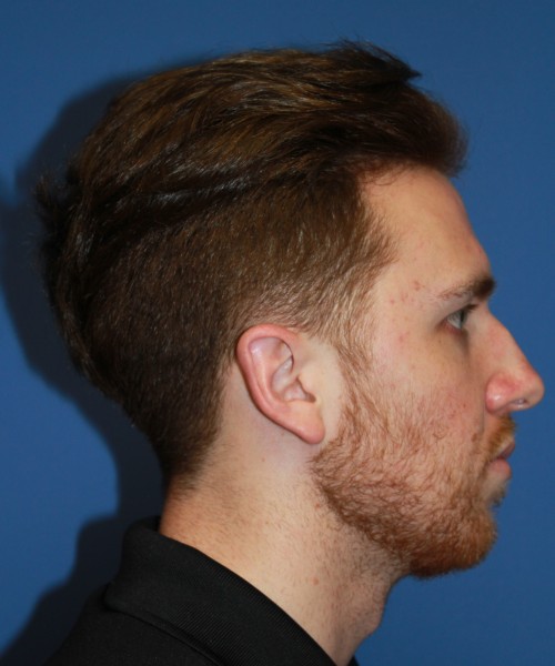 Rhinoplasty 2182 – Click HERE for more views before photo. Individual results may vary.