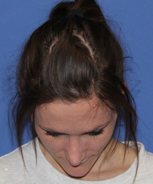 Rhinoplasty and Otoplasty 2213 – Click HERE for more views after photo. Individual results may vary.