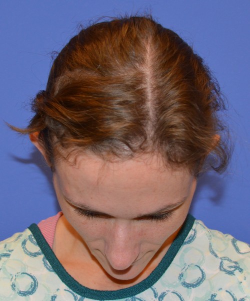 Rhinoplasty and Otoplasty 2213 – Click HERE for more views before photo. Individual results may vary.