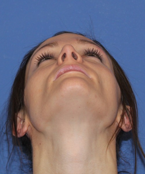 Rhinoplasty and Otoplasty 2213 – Click HERE for more views after photo. Individual results may vary.