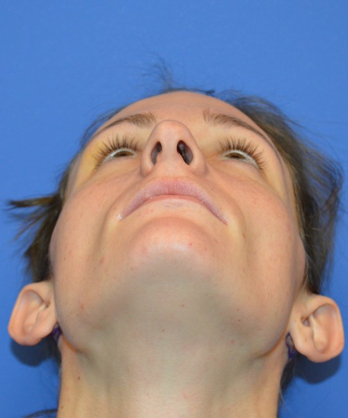 Rhinoplasty and Otoplasty 2213 – Click HERE for more views before photo. Individual results may vary.