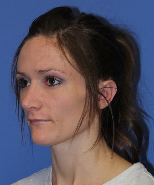 Rhinoplasty and Otoplasty 2213 – Click HERE for more views after photo. Individual results may vary.