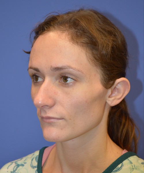Rhinoplasty and Otoplasty 2213 – Click HERE for more views before photo. Individual results may vary.